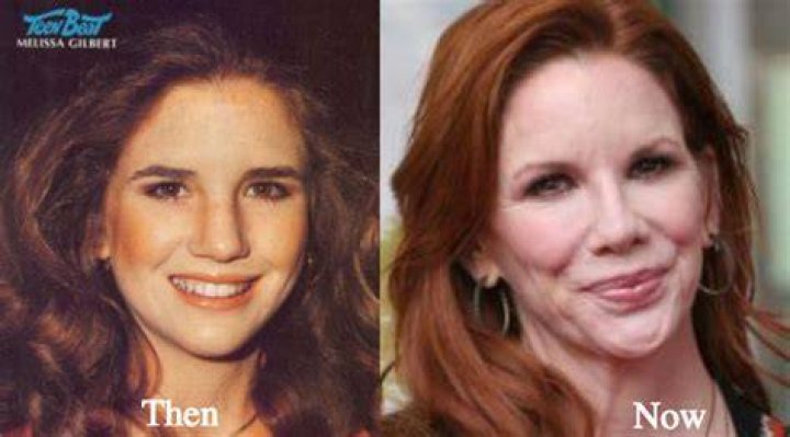 Celebrity Melissa Gilbert Plastic Surgery Nose Jobe Before After