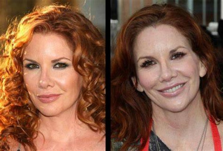Unveiling The Secrets Of Melissa Gilbert's Plastic Surgery Journey: Discoveries And Insights